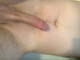 Lobonc